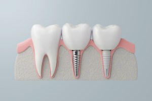 two types of dental implants next to normal tooth