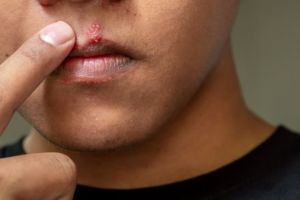 man with cold sore on lip