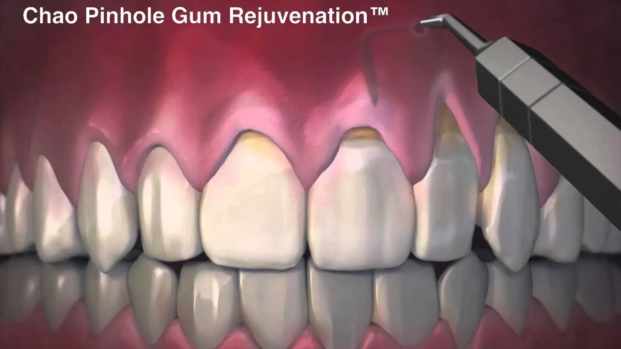 Chao Pinhole Gum Rejuvenation Chao Pinhole Surgical Technique Video Thumbnail