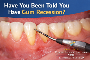 gum recession treatment in winchester