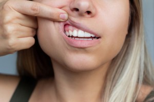 Woman showing her gums
